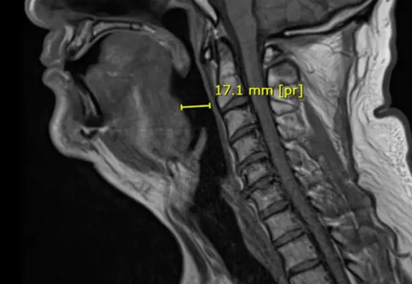 bttt-osa-implant-mri-640